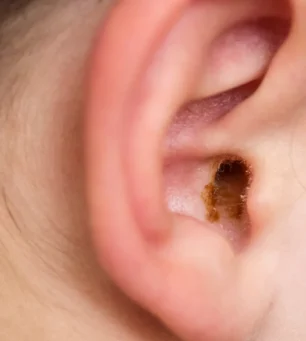 microsuction-ear-wax-8 microsuction-ear-wax-8